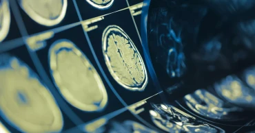 মাথা-ঘাড়ের ক্যানসারে দ্বিগুণ কার্যকরী ওষুধ আবিষ্কার