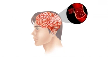 তরুণদের মধ্যে স্ট্রোকের প্রবণতা বেড়ে যাচ্ছে: জানুন কারণ, লক্ষণ ও প্রতিরোধ