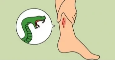 সাপের কামড়ের চিকিৎসায় সব উপজেলায় এন্টিভেনম সরবরাহে নির্দেশ