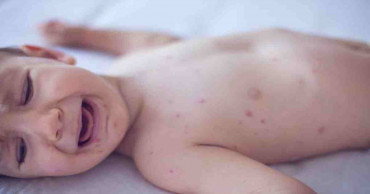 Global measles deaths up 50% since 2016
